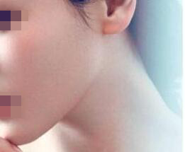 下颌角发育过度的“方形脸”患者，一个手术可以带来什么样的改变
